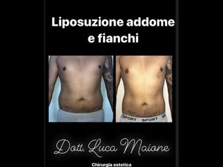 Liposuzione - Dott. Luca Maione