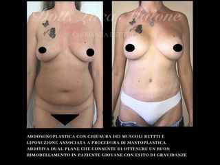 Addominoplastica - Dott. Luca Maione