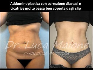 Addominoplastica - Dott. Luca Maione