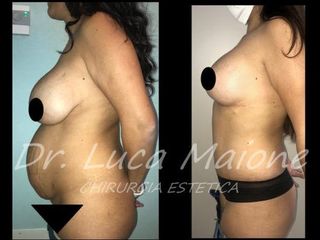 Liposcultura - Dott. Luca Maione