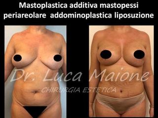 Liposcultura - Dott. Luca Maione