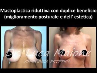 Mastoplastica riduttiva - Dott. Luca Maione
