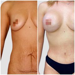 Dott. Luca Maione Mastoplastica additiva + addominoplastica