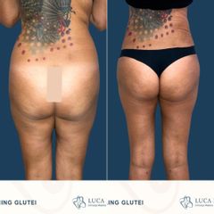 Dott. Luca Maione Liposcultura