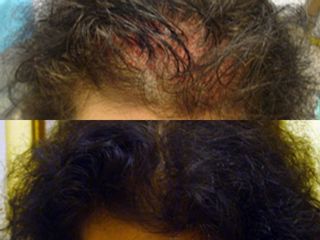Trapianto capelli prima e dopo