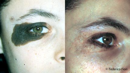 Macchie della pelle prima e dopo