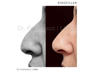 Rinofiller - Dott. Francesco Lino