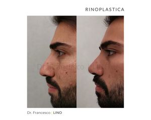 Rinoplastica - Dott. Francesco Lino