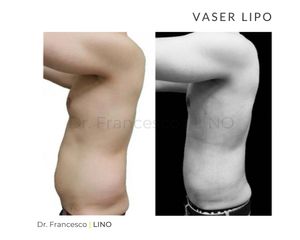 Liposuzione - Dott. Francesco Lino