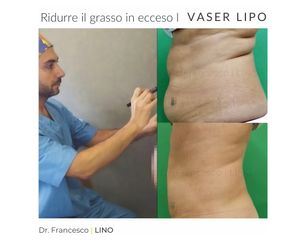 Liposuzione - Dott. Francesco Lino