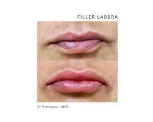 Filler labbra - Dott. Francesco Lino