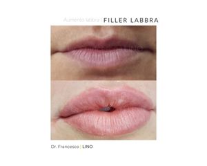 Filler labbra - Dott. Francesco Lino