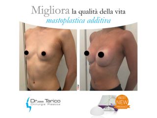 Mastoplastica additiva prima e dopo