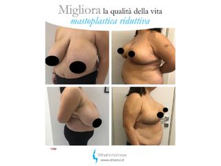 Mastoplastica riduttiva prima e dopo