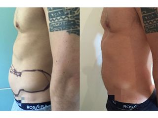 Pre post liposuzione