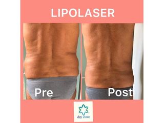 Lipolaser prima e dopo