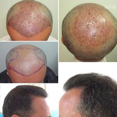 Trapianto di Capelli - AraMedica