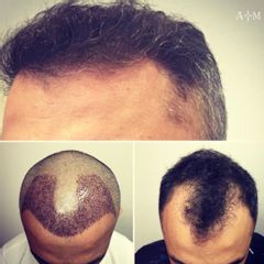 Trapianto di Capelli - AraMedica