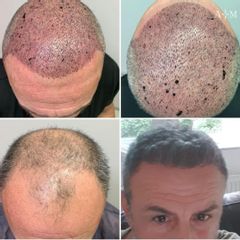 Trapianto di Capelli - AraMedica