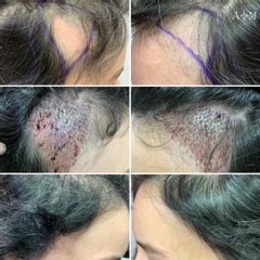 Trapianto di Capelli - AraMedica