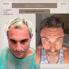 Trapianto di Capelli - AraMedica