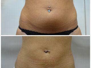 Liposcultura