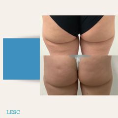 Liposuzione - Dott. Stefano Toschi