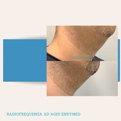 Radiofrequenza - Dott. Stefano Toschi