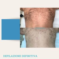Depilazione Laser - Dott. Stefano Toschi