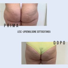 Cellulite - Dott. Stefano Toschi