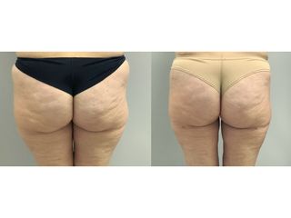 Liposuzione  - Dott. Stefano Toschi