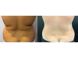 Liposuzione  - Dott. Stefano Toschi