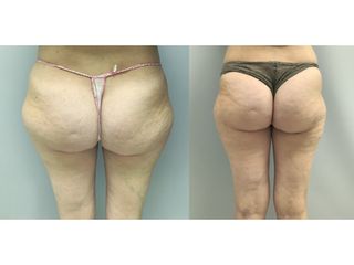 Liposuzione  - Dott. Stefano Toschi