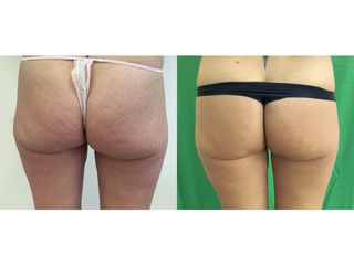 Liposuzione  - Dott. Stefano Toschi