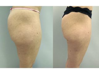 Liposuzione  - Dott. Stefano Toschi