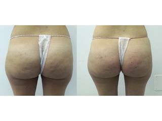 Liposuzione  - Dott. Stefano Toschi