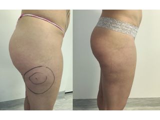 Liposuzione  - Dott. Stefano Toschi