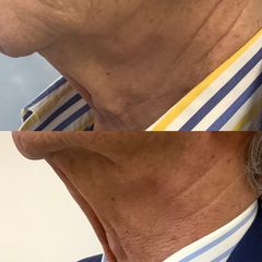 Dott. Stefano Toschi Lifting collo