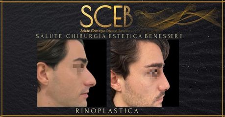 Rinoplastica - SCEB Salute Chirurgia Estetica Benessere - Dott. Manuel De Giovanni
