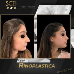 Rinoplastica - SCEB Salute Chirurgia Estetica Benessere - Dott. Manuel De Giovanni