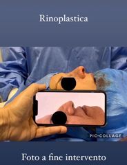 Rinoplastica - Dott. Massimiliano Sparacello - Novamedis Day Surgery