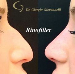 Rinofiller - Dr. Giorgio Giovannelli