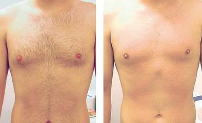 Epilazione petto prima e dopo