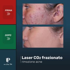 Laser CO2 frazionato - Dott Luigi Petti
