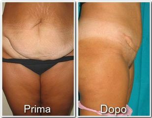 Addominoplastica prima e dopo
