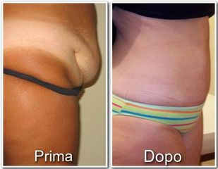 Addominoplastica prima e dopo