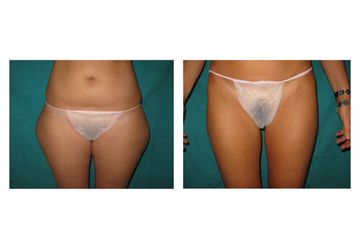 Liposuzione prima e dopo