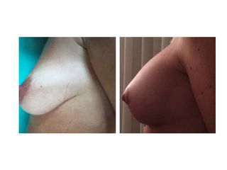 Mastoplastica prima e dopo