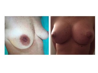 Mastoplastica prima e dopo