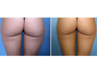 Laserlipolisi prima e dopo
